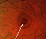 Разрыв сетчатки глаза википедия thumbnail