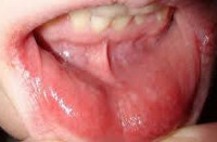 Аллергический стоматит у взрослых симптомы и лечение фото thumbnail