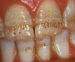 Некроз твердых тканей зуба лечение thumbnail