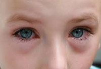 Причины появления конъюнктивита глазного у детей thumbnail
