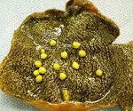 Желчный пузырь стенки с признаками холестероза thumbnail