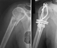 Перелом хирургической шейки плечевой кости со смещением у ребенка thumbnail