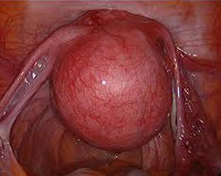 Метод диагностики субсерозной миомы матки thumbnail
