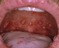 При медикаментозном стоматите возможно появление на коже тела thumbnail