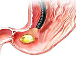 Лечение перфорирующей язвы желудка thumbnail