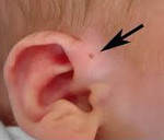 Свищ на ухе у ребенка лечение в домашних условиях thumbnail
