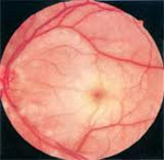 Ишемическая нейрооптикопатия глаза лечение thumbnail
