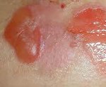 Эксфолиативный дерматит риттера лечение thumbnail