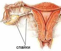 Спайки маточных труб менструация thumbnail