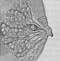 Внутрипротоковая папиллома молочной железы thumbnail