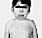 Синдром тернера у детей симптомы thumbnail