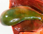 Осложнения холецистита холангит эмпиема желчного пузыря thumbnail
