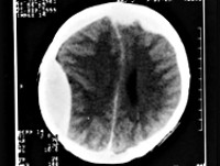 Сдавление головного мозга посттравматической гематомой thumbnail