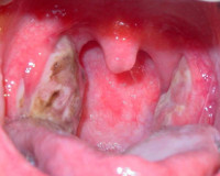 Дифференциальная диагностика ангины венсана thumbnail