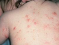 Шистосоматидный аллергический дерматит церкариоз лечение thumbnail