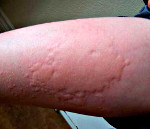 Пенициллиновая аллергия как и чем лечить thumbnail