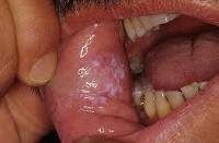 Клинические формы кандидоза полости рта thumbnail