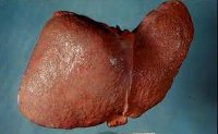 Первичный билиарный цирроз печени холестаз thumbnail