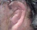 Атрезия слухового прохода