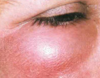 Лечение при рожистое воспаление глаза thumbnail