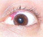 Травма глаза симптомы лечение thumbnail