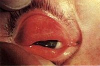 Трахома глаз симптомы и лечение фото thumbnail