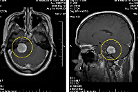 Опухоль головного мозга без болей thumbnail
