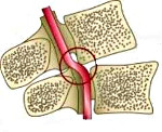 Что такое синдром вертебральных артерий thumbnail