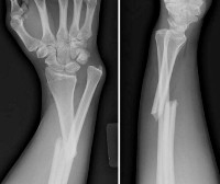 Причины смещения костных отломков при переломах thumbnail