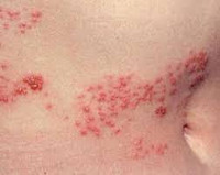 Вирусные инфекции кожи герпес thumbnail