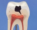 Кариес зубов клиника диагностика лечение thumbnail