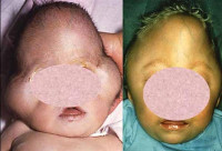 Синдромом пфайффера до и после операции thumbnail