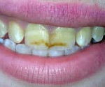 Болезни твердых тканей зубов и их профилактика thumbnail