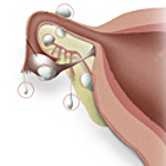 Операция по поводу параовариальной кисте яичника thumbnail