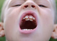 Сверхкомплектный зуб лечение thumbnail