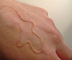 Что такое кожный синдром larva migrans thumbnail