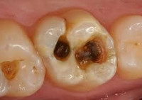 Лечение среднего и глубокого кариеса зубов thumbnail