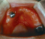 Аллергия на стоматологические материалы как проверить thumbnail