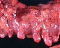 Дивертикулярная болезнь ободочной кишки код мкб 10 thumbnail