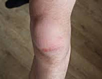 Травма коленного сустава диагностика thumbnail