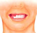 Вторичная частичная адентия зубов лечение thumbnail