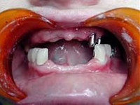 Полная адентия зубов лечение thumbnail