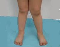 Х образные ноги у подростков лечение thumbnail