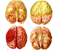 Отек мозга при нейроинфекции thumbnail