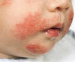 Симптомы кожного дерматита у детей thumbnail