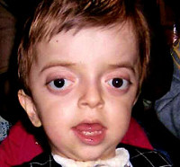 Ребенок с синдромом крузона фото thumbnail