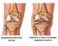 Гепатоз коленного сустава лечение thumbnail
