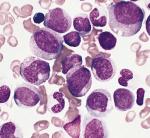 Что такое monocytosis в анализе крови thumbnail