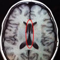 Внутриутробное нарушение развития головного мозга ребенка thumbnail