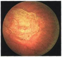 Центральная хориоретинальная дистрофия сетчатки глаза thumbnail